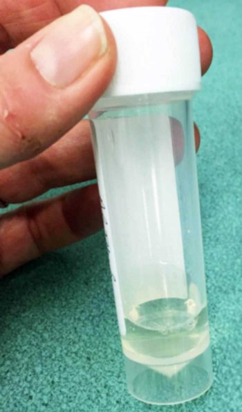 Urinalysis – and, in particular, urine specific gravity assessment – can be very helpful in facilitating an early diagnosis of chronic kidney disease. Free catch or cystocentesis samples are suitable for this assessment.