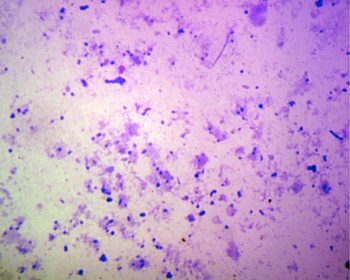 <strong>Figure 1b</strong>. The condition in <strong>Figure 1a</strong> is associated with bacterial overgrowth. 