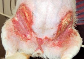 <strong>Figure 4</strong>. Calcinosis cutis as a result of chronic topical glucocorticoid administration.