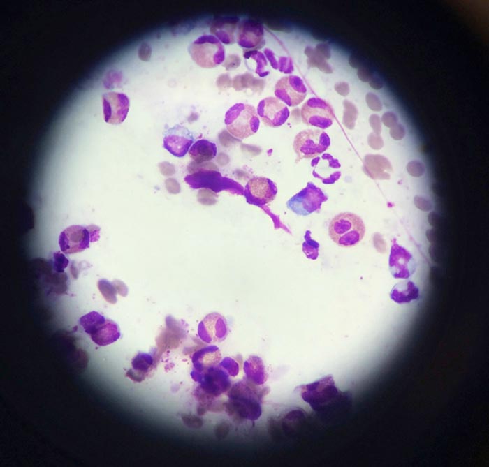 An impression smear from a suspected eosinophilic granuloma complex lesion on a cat with a large numbers of eosinophils.