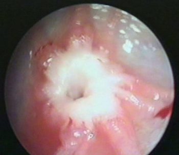 Figure 4. Exploratory theloscopy showing the internal opening of the teat orifice, with prolific connective tissue that was responsible for the teat stenosis. Image: Rupert Ebner