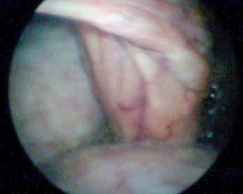 Figure 6. Exploratory laparoscopy showing a cystic ovary (left ovary), suspended below the broad ligament. Image: Sotirios Karvountzis