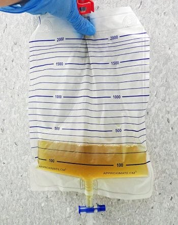 Figure 4. A urine collection bag. This should be attached to the indwelling urinary catheter to achieve a closed system.