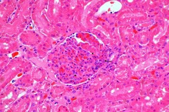 Figure 6. Neutrophilic glomerulitis (arrow) with vascular necrosis and thrombosis (arrowheads). Hematoxylin and eosin stain, magnification ×200. Image: Bridge Pathology.