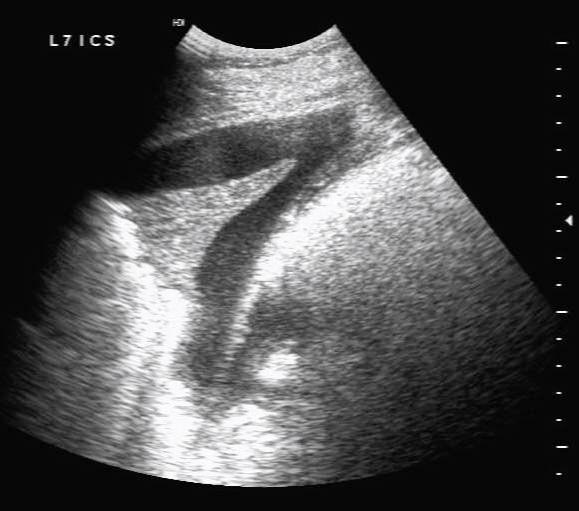 Figure 10. An ultrasonographic image of consolidation of the cranioventral lung in a horse with aspiration pneumonia. The reverberation artefact is lost and the lung tissue has become hypoechoic with visible architecture as air has been forced out by fluid and inflammatory infiltrates. The hyperechoic regions represent areas that remain aerated.