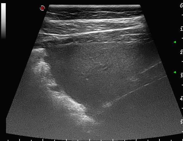 Figure 12. An ultrasonograph of the ventral thorax from a colt with Rhodococcus equi pneumonia. The ventral lung is no longer aerated and a clear hyperechoic line defines the border between aerated and non-aerated lung tissue.