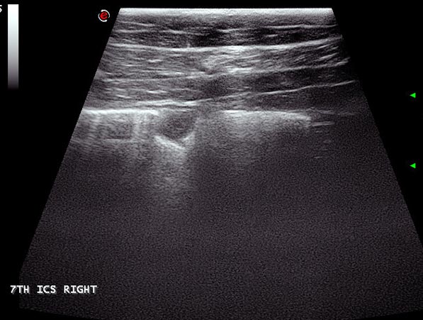 Figure 13. An ultrasonograph of the lung of an eight-week-old foal with Rhodococcus equi pneumonia. The reverberation artefact of the pleural surface was lost as aerated tissue has been replaced by the abscess. An irregular hyperechoic line deep to the abscess indicates the air interface deep to the pleural surface. The irregular pleural surface adjacent to the abscess has given rise to “comet tails”.