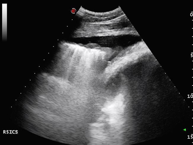 Figure 7. An ultrasonograph of the ventral thorax from a horse with pleuropneumonia. The pleural space contains anechoic pleural fluid.