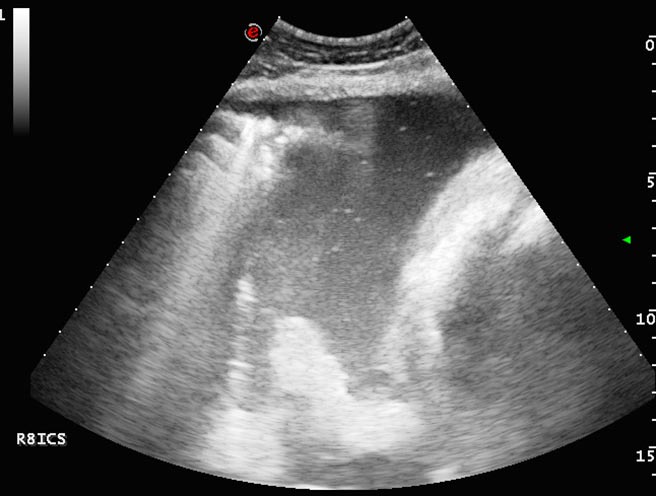 Figure 8. An ultrasonograph of the ventral thorax from a horse with pleuropneumonia. The pleural space contains a large quantity of pleural fluid with hyperechoic flecks consistent with the presence of gas or cellular material. This is the same horse as shown in Figure 7, but later in the course of disease.