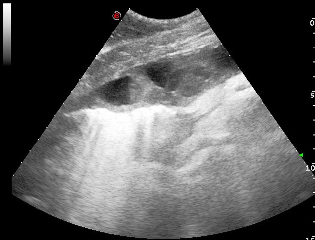 Figure 9. An ultrasonograph of the ventral thorax from a horse with pleuropneumonia A loculated pleural effusion is present; anechoic fluid is seen surrounded by echogenic fibrin. Multiple hyperechoic comet tails are seen at the lung surface. Note the surface of the pulmonary structures is deflected from the thoracic wall and is undulating in contour.