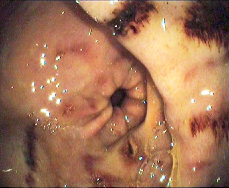 Figure 2a. Equine squamous gastric disease ulceration of the glandular mucosa around the pylorus that appears multifocal, moderate, flat and haemorrhagic.