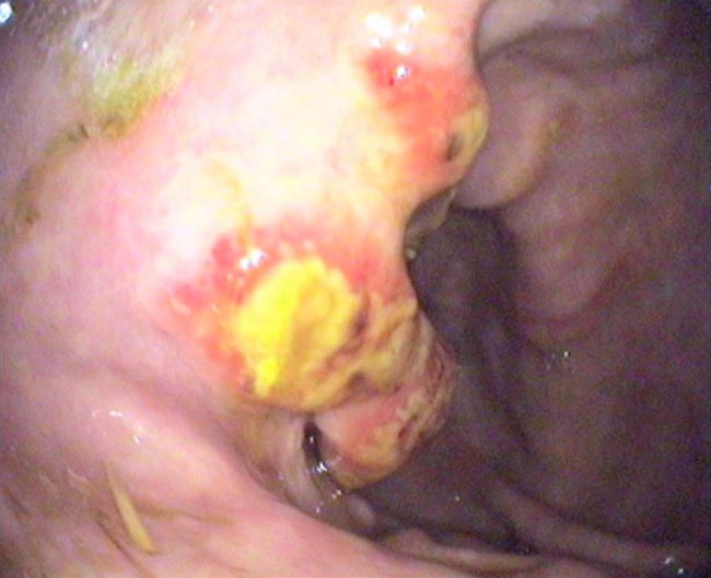 Figure 2b. Equine squamous gastric disease ulceration of the glandular mucosa around the pylorus that appears multifocal, moderate, raised and fibrinosuppurative.