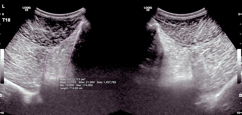 Figure 3. Measurement of the left multifidus muscle at the T18 vertebra