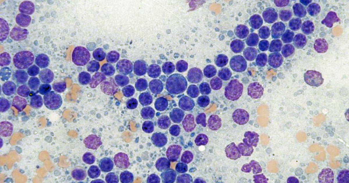 Figure 1. Cytological appearance of small cell lymphoma. Note the predominance of small lymphocytes with a mildly to moderately expanded population of small to medium lymphocytes. Rare large lymphocytes are seen. In this case, the diagnosis of lymphoma was confirmed via flow cytometry. Modified Wright stain 50× magnification. Image © Jennifer Stewart