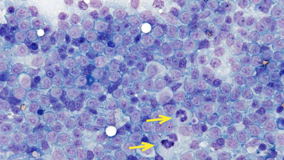 Figure 2. Cytological appearance of large cell lymphoma. Note the highly cellular sample and the predominance of large lymphocytes (one to two times the diameter of neutrophils) with a small amount of deeply basophilic cytoplasm. Two mitotic figures are present (yellow arrows). Modified Wright stain 50× magnification. Image © Jennifer Stewart