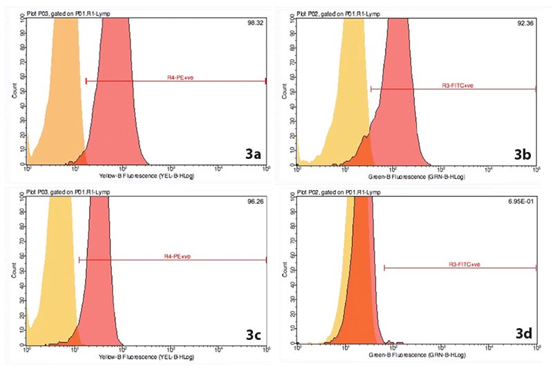 Figure 3. Flow cytometry immunostaining profile for a case of diffuse large B-cell lymphoma. Note the positivity to cluster of differentiation (CD)79a (3a), major histocompatibility complex II (3b) and CD21 (3c), while CD3 marker of T-cells resulted negative (3d). Images © Paola Monti