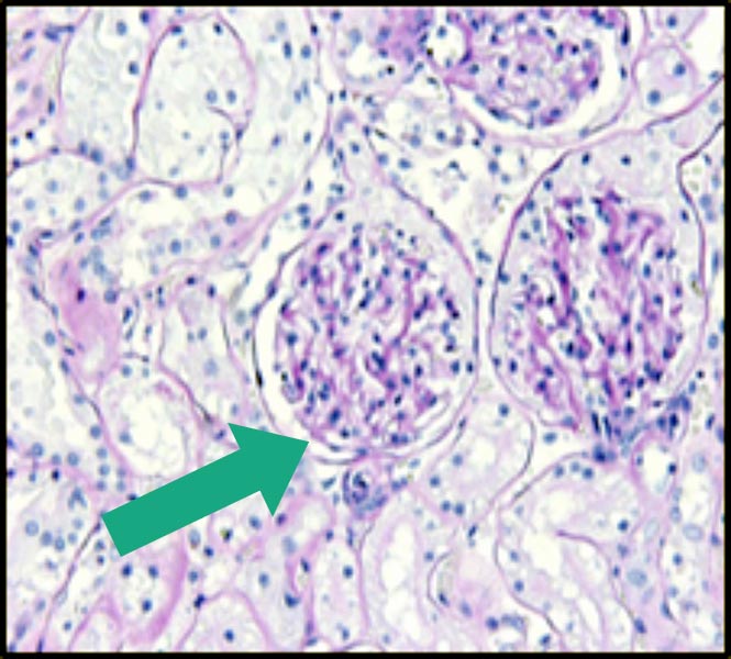 Figure 1a. Glomerular changes with hypertension and chronic kidney disease. Normal feline glomerulus (green arrow).