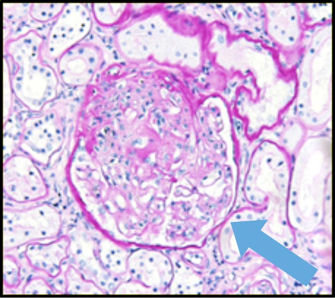 Figure 1b. Glomerular changes with hypertension and chronic kidney disease. Glomerulus from a cat with chronic kidney disease and hypertension demonstrating glomerular hypertrophy (increase in size and volume of glomerulus) and glomerulosclerosis (thickening of basement membrane and mesangial matrix expansion; blue arrow).