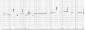 Figure 1. An extract from a resting ECG obtained later over a 24-hour period using a Holter system recorded at paper speed 25mm/s2.