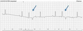 Figure 2. A resting 24-hour ECG segment showing two ventricular premature depolarisations (arrows) – the first of which is interpolated.