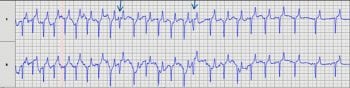 Figure 3. An excerpt from the exercising ECG as the gelding starts to slow following fast work, showing the presence of ventricular premature depolarisation (VPD; arrows). The trace confirms the presence of VPD at exercise, which is of particular importance in an animal that is maximally exercising.