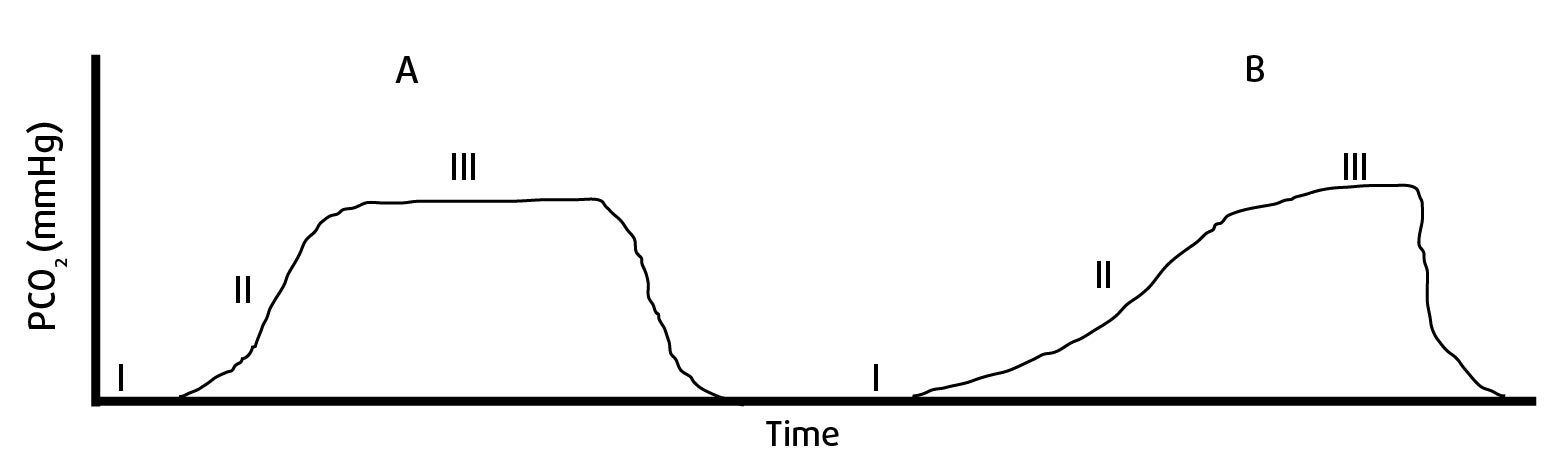 Figure 4. (A) a normal capnogram and (B) a capnogram expected with bronchoconstriction. Phase I – inspiratory baseline, phase II – start of expiration (note a slow ascent with graph B), phase III – alveolar phase (note the loss of alveolar phase with graph B).