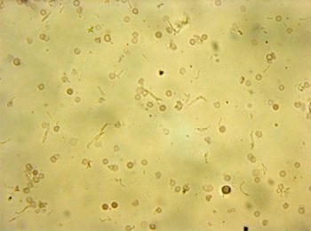 Figure 2a. Urine sediment of urine from a dog with Proteus species urinary tract infection (UTI). Chains of bacilli can be seen alongside frequent red blood cells, leukocytes and debris.