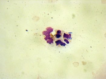 Figure 2b. Cytospin preparation of urine from the same dog in Figure 2a with Proteus species UTI. Bacilli can be seen within a neutrophil (red arrow), which confirms septic neutrophilic inflammation.
