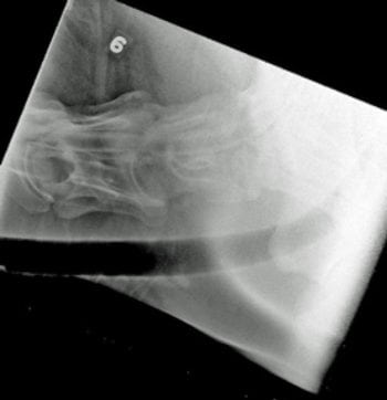 Figure 2b. An 18-month-old Thoroughbred colt with moderate ataxia (grade two in the pelvic limbs, grade one in the thoracic limbs). Lateral radiograph with positive contrast myelography at the level of C6-T1 shows attenuation of the dorsal dye column at the C6-C7 articulation.