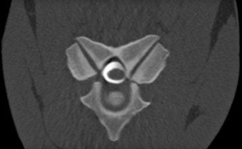 Figure 3b. An image acquired from a patient with neck pain but no neurological deficits; reconstructed transverse CT myelogram at the level of the C5-C6 articulation. A reduction is seen in the lateral dye column secondary to bony enlargement of the adjacent articular process joint, which would probably not have been visible on radiographic myelography. Image: Rachel Tucker, Liphook Equine Hospital.