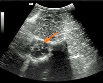 Figure 1. Ultrasonographic appearance of the spinal canal between C1 and C2 obtained with the ultrasound probe positioned dorsolaterally on the neck (dorsal, C1, is to the left). The arrow marks the subarachanoid space.