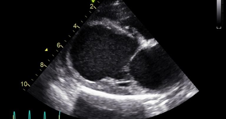 Dilated cardiomyopathy in dogs causes and treatment Vet