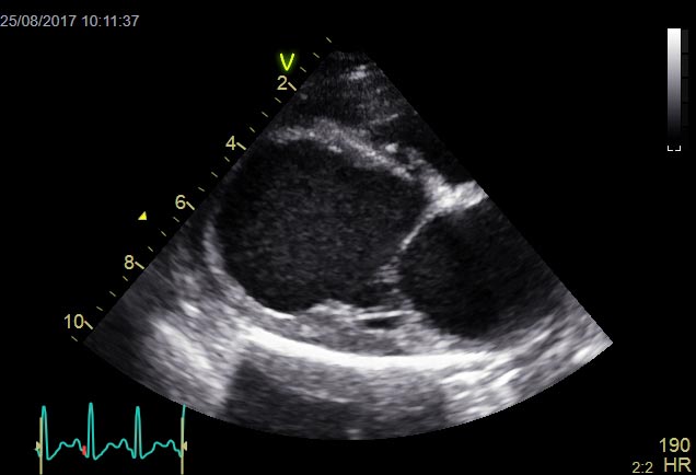 Figure 1a. Right parasternal long axis, four-chamber view of the heart of a Labrador retriever with dilated cardiomyopathy (DCM), depicting a thin-walled, dilated and rounded left ventricle.