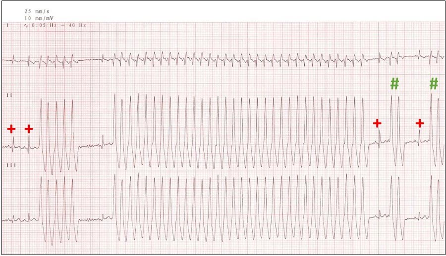 Figure 3. An ECG from a dog with dilated cardiomyopathy, showing an episode of fast ventricular tachycardia at approximately 330 beats per minute, with R-on-T phenomenon, and occasional sinus complexes (+) and couplets (#). The presence of two differing QRS morphologies enables differentiation between sinus-origin and ventricular-origin complexes.