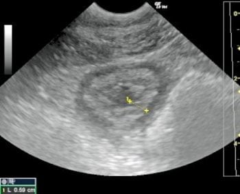 Figure 2. The markedly thickened wall of the small intestine of 0.59cm.