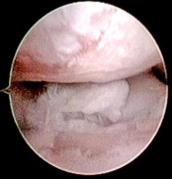 Figure 1. Arthroscopic image of elbow arthritis.