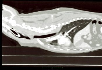 Figure 2. A sagittal CT image of the tracheal mass.