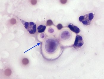 Figure 1 (main and below). Photomicrographs of the CSF of a dog with neurological signs; Wright-Giemsa 50×-100×.