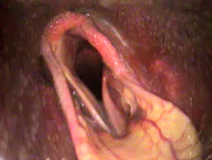 An endoscopic image of the pharynx and larynx in a horse with recurrent laryngeal neuropathy.