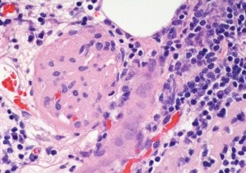 Figure 1b. Histological section of renal cortex showing glomerular sclerosis with interstitial inflammatory infiltrate (haematoxylin and eosin stain). Image: Linda Morrison, The University of Edinburgh