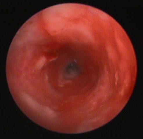 Figure 3. Ulceration of the vertical ear canal on the same dog as shown in Figure 1.