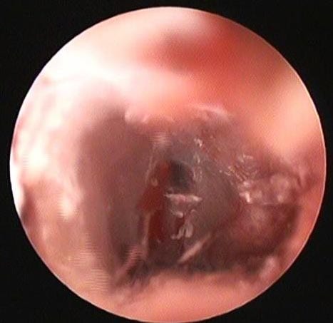 Figure 4. Myringotomy performed with a 4F tomcat urinary catheter in a dog.