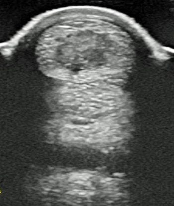 Figure 1. A superficial digital flexor tendon core lesion.