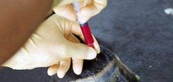 Figure 2. A platelet-rich plasma injection.