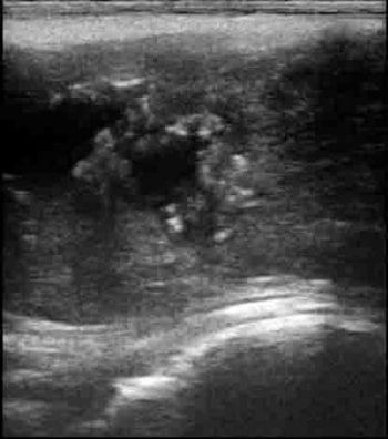 Figure 14. Diagnosis of a varicocele on ultrasound examination of the testes.
