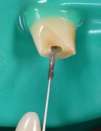 Figure 3. The contents of a necrotic pulp.