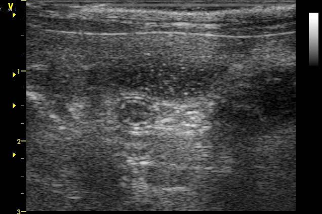 Figure 2b. An ultrasound of a cat presenting with an obstructive small intestinal foreign body showing dilated and non-dilated small intestinal loss.