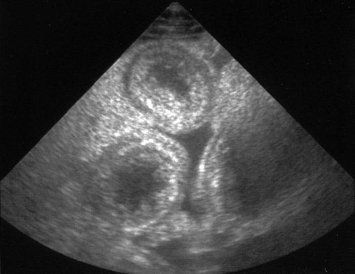 Figure 3a. An ultrasound of a dog presenting with haemorrhagic diarrhoea associated with small intestinal volvulus showing loss of intestinal wall layering.