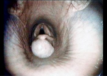 Figure 1. A videoendoscopic image demonstrating the large subepiglottic cyst at presentation. Note the secondary elevation of the epiglottis.