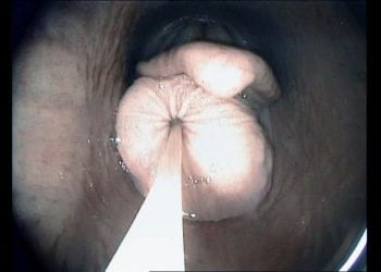 Figure 2. A transendoscopic lance is used to aspirate contents to deflate the cyst.